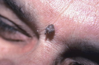 Cat:5zohry-Oewo= Cutaneous Horn