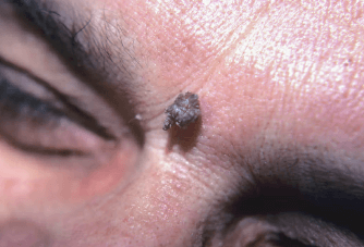 Cat:5zohry-Oewo= Cutaneous Horn